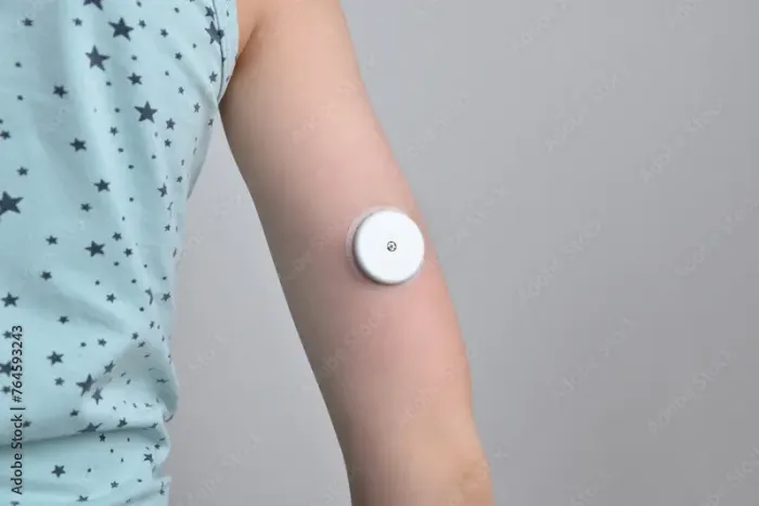 Continuous Glucose Monitoring in Pediatric Diabetes